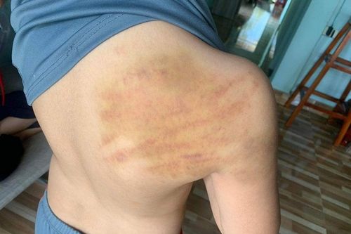 Yêu cầu chấm dứt việc dạy thêm tại nhà đối với người đánh bầm tím lưng học sinh lớp 5 tại Phú Yên