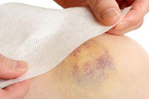 Xuất hiện vết bầm tím trên da, rất có thể bạn đang mắc bệnh này, đây là dấu hiệu cần được khám sớm