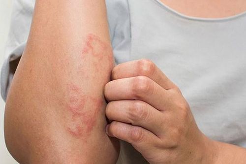 Thay đổi thời tiết liên tục: Không chủ quan với viêm da cơ địa