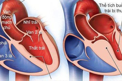 Bệnh cơ tim: Nguyên nhân, triệu chứng và cách điều trị
