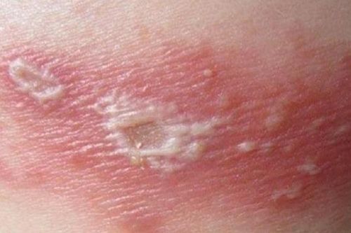 Những ai dễ mắc bệnh zona thần kinh?