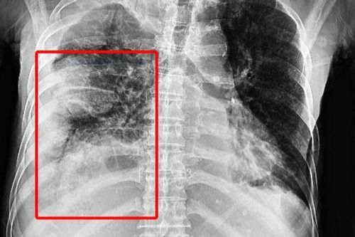 Cứu sống người đàn ông tràn mủ màng phổi sau chấn thương