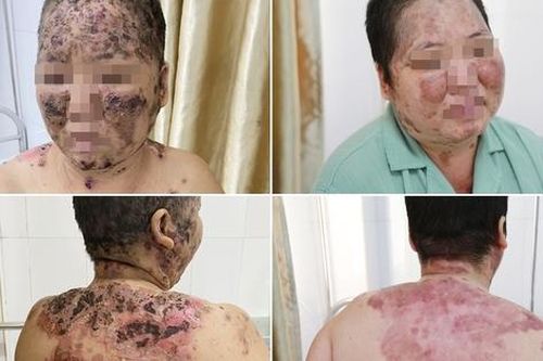 Người phụ nữ bị bệnh da bội nhiễm toàn thân nguy kịch vì tắm lá