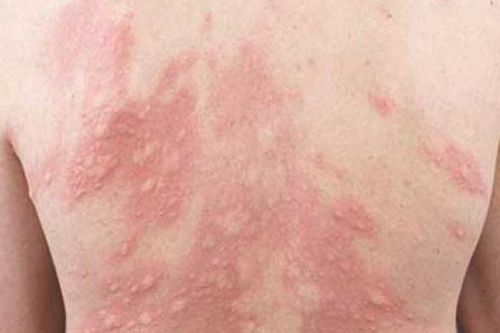 Cần làm gì khi bị nổi mề đay?