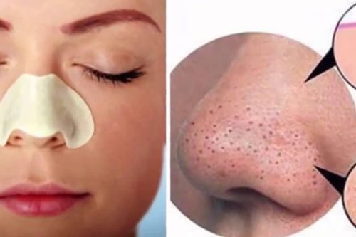 Bật mí 7 cách trị mụn đầu đen hiệu quả tại nhà