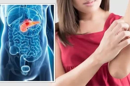 Triệu chứng sớm ở 75% bệnh nhân ung thư tuyến tụy