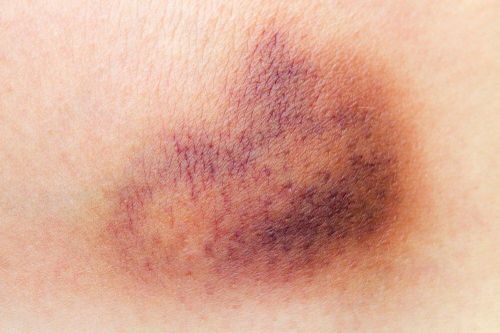 Ung thư máu giai đoạn đầu có biểu hiện gì?