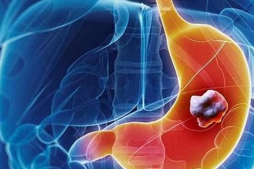 Hiểu thêm về dị sản ruột dạ dày