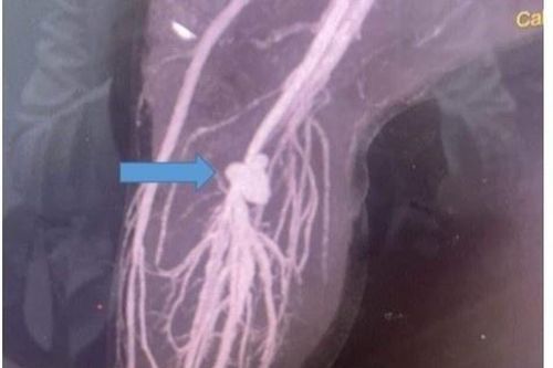 Bé trai bị kéo đâm tổn thương động mạch, suýt phải đoạn chi