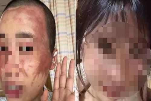 Không chịu sinh con thứ 2, vợ bị chồng tạt axit