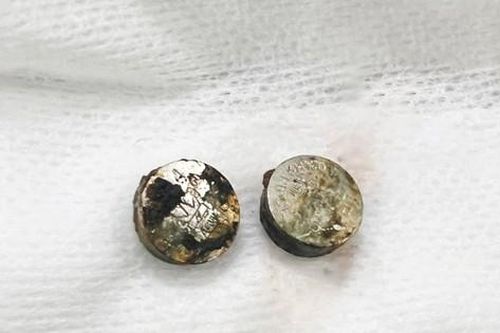 Lấy pin bị cháy khét trong mũi bé gái 6 tuổi