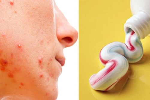 Mặt 'nở hoa' sau 2 tháng theo Tiktok chữa mụn bằng kem đánh răng