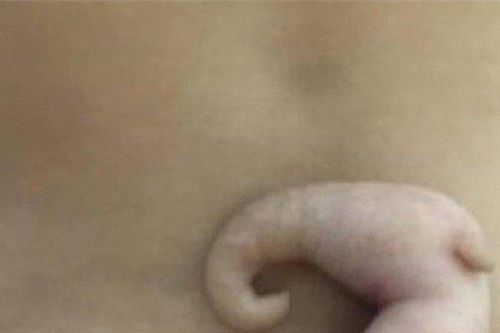 Hi hữu bé gái sinh ra với chiếc đuôi dài 6cm