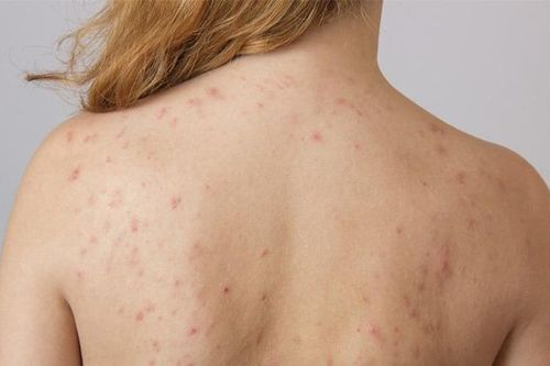 Các loại mụn thường mọc trên lưng chị em cần biết