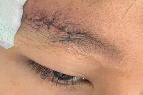 Nghịch súng hơi, bé trai bị viên đạn chì găm sâu vào xương sọ