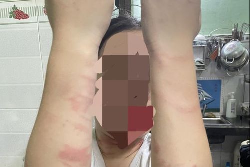 Thiếu nữ 17 tuổi ở TP.HCM bị mẹ đánh gây nhiều thương tích