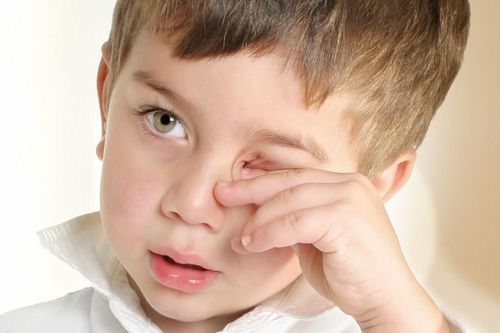 Triệu chứng đau mắt đỏ phổ biến ở trẻ