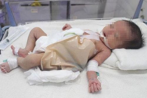 Sinh con tại nhà, 7 ngày sau mới phát hiện bé không có hậu môn