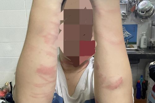 TP Hồ Chí Minh: Điều tra vụ thiếu nữ 17 tuổi bị mẹ đánh gây nhiều thương tích