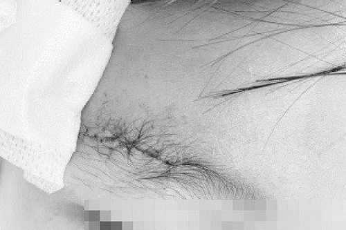 Nghịch súng hơi, bé trai 10 tuổi bị đạn găm vào xương sọ