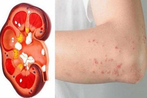 Trả lời 'có' với 4 câu hỏi này là thận đang 'gửi lời' cảnh báo bệnh nặng, hãy nhanh chân đến gặp bác sĩ