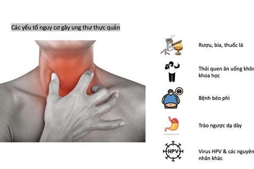 Những thói quen ăn uống làm tăng nguy cơ ung thư thực quản