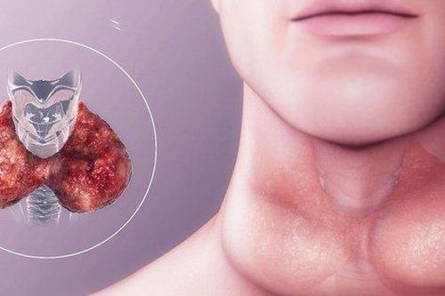 U nang giáp lưỡi không nên bỏ qua