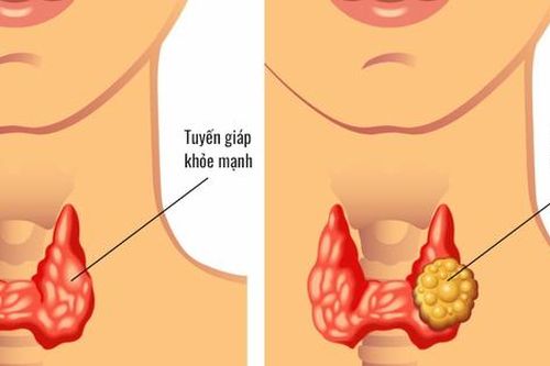 Bướu nhân tuyến giáp là gì? Biểu hiện mắc bướu nhân tuyến giáp