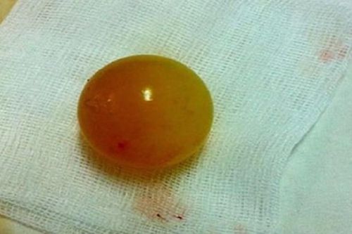 Bé gái 13 tháng tuổi bị tắc ruột do nuốt phải hạt nở