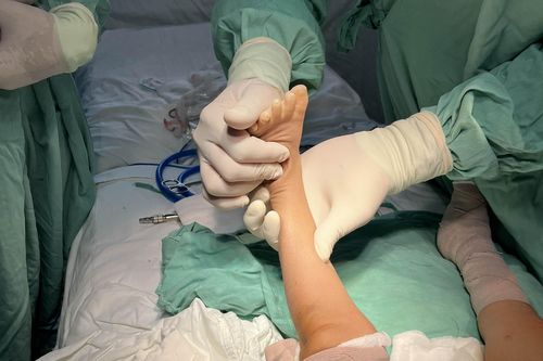 Tìm lại đôi chân cho bé gái bị khoèo bẩm sinh