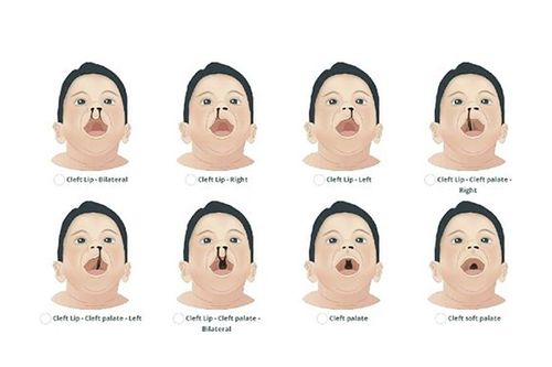 Cơ hội cho trẻ em Hà Tĩnh bị dị tật sứt môi, hở hàm ếch được phẫu thuật miễn phí