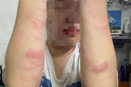 Vụ nữ sinh 17 tuổi bị mẹ đánh thương tích: Đang làm rõ hành vi của người mẹ
