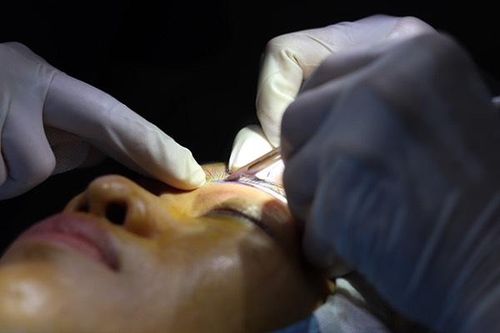 Nhấn mí và cắt mí hỏng gây nhiều biến chứng và làm thay đổi 'hồn mắt'