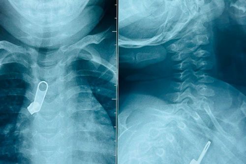 Bé trai 15 tháng tuổi bị kẹt móc khóa kéo trong đường thở
