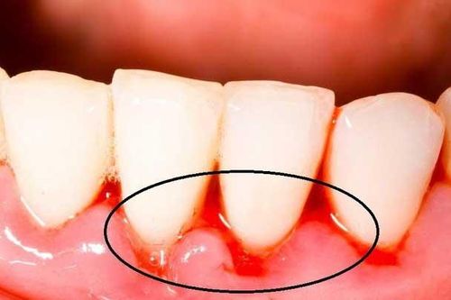 6 triệu chứng bất thường ở răng miệng cảnh báo nhiều vấn đề nguy hại, đặc biệt là cái số 1