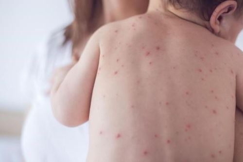 Bệnh về da thường gặp ở trẻ nhỏ mẹ cần lưu ý