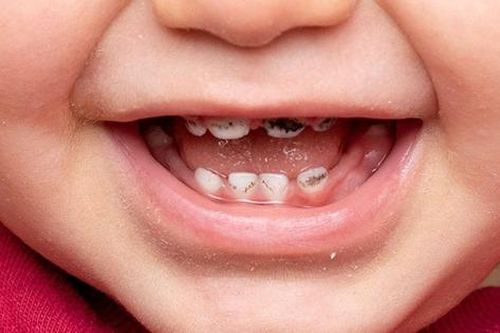 Những việc cha mẹ cần làm khi trẻ bị sâu răng