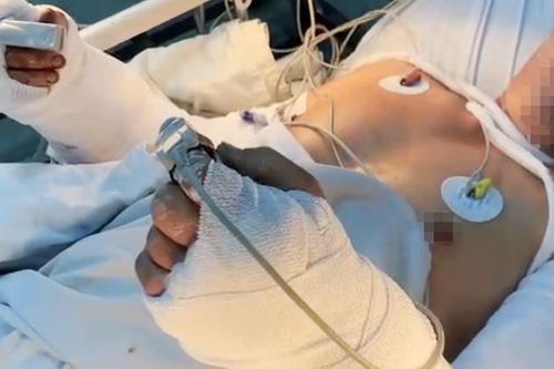 Người đàn ông nhập viện với 2 bàn tay đứt lìa