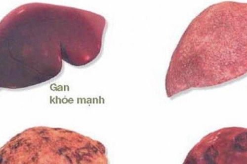 Những người nào dễ mắc ung thư gan, cần đi khám sớm?