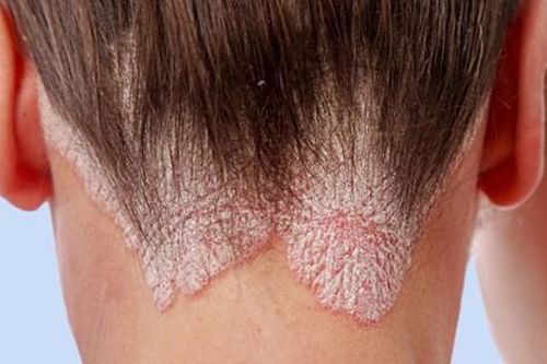 Thuốc chữa vẩy nến có thể kiểm soát rối loạn sử dụng rượu