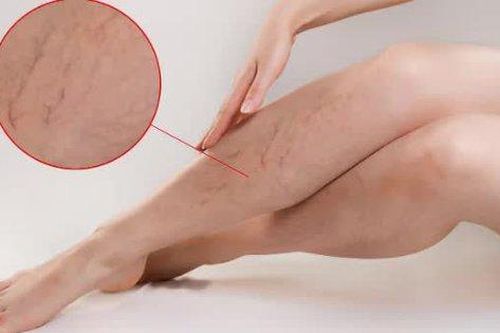 7 giải pháp hỗ trợ cải thiện chứng suy giãn tĩnh mạch chân