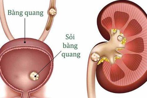 Nhận biết triệu chứng của sỏi bàng quang và cách điều trị