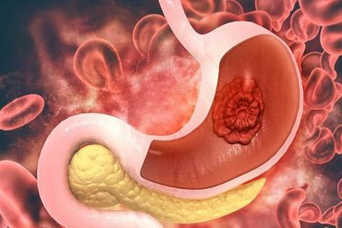 7 dấu hiệu cảnh báo ung thư dạ dày cần phải khám ngay