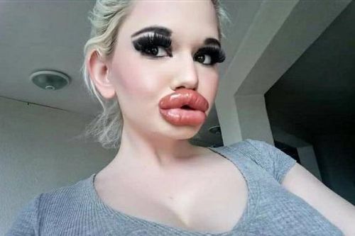 Cận cảnh 'đôi môi lớn nhất thế giới' sau hơn 30 lần tiêm filler