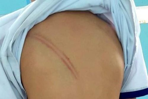 Xác minh vụ mẹ kế ở Cà Mau đánh con chồng hàng chục vết bầm tím