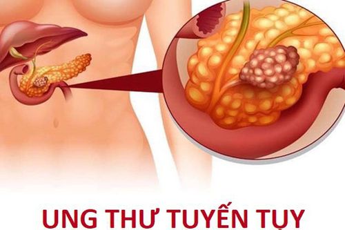 Triệu chứng ung thư tuyến tụy giai đoạn đầu
