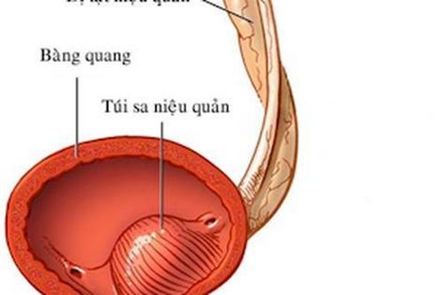 Đau tức bụng, vùng thắt lưng, tiểu khó… thận trọng với bệnh lý thận - niệu quản đôi