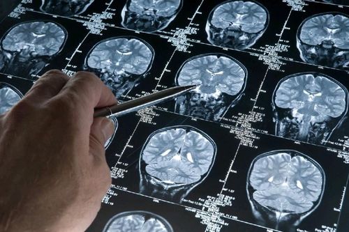Triển vọng điều trị bệnh Parkinson bằng sóng siêu âm