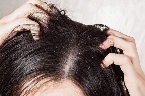 3 công thức trị gàu trong mùa hè hiệu quả