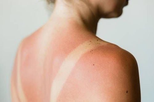 Tia cực tím phá hủy làn da như thế nào?